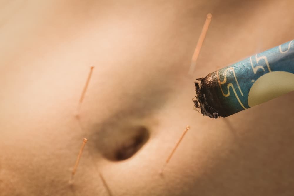 Une jeune femme reçoit un traitement acupuncture